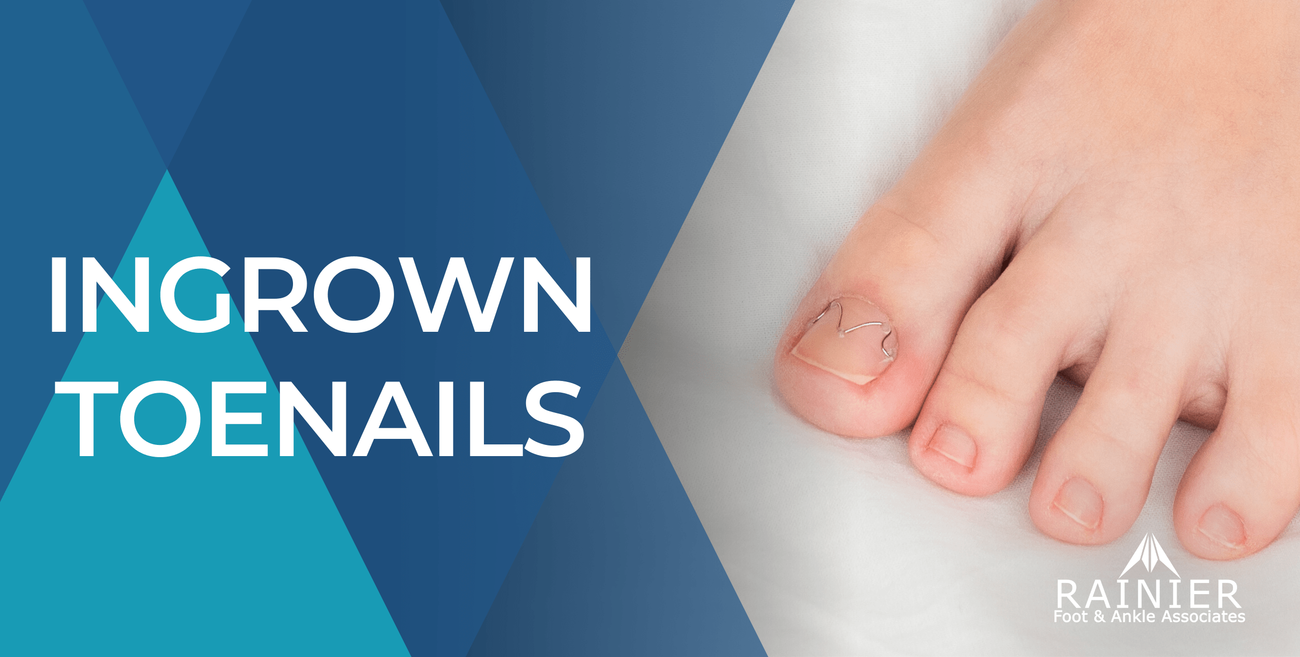 Webpage Graphic Ingrown Toenail Webpage Graphic Ingrown Toenail